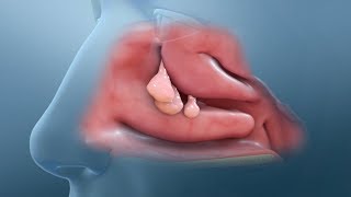 Nasal Polyp Removal Surgery [upl. by Waterer]