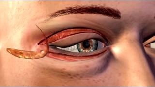 Cosmetic Eye and Eyelid Surgery  3D Medical Animation  ABP © [upl. by Dream495]