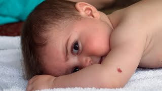 The Truth About Birthmarks Revealed [upl. by Aihsirt]