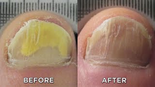 Nail Fungus Zap It with New Laser Treatment [upl. by Aim]