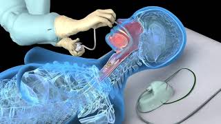 Nasotracheal suctioning NTS  3D animation [upl. by Nuhsyar547]