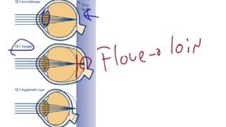 Myopie presbytie et hypermétropie [upl. by Scevor]
