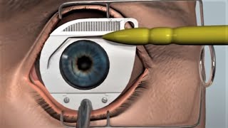 LASIK eye surgery  3D animation [upl. by Healion]