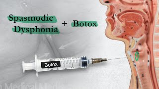 Spasmodic Dysphonia  When Botox Disappoints  Part 2 [upl. by Larcher198]