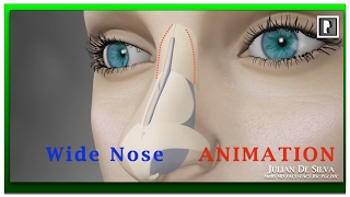 Rhinoplasty Animation  How can a Wide nose be narrowed [upl. by Ardnohsed]