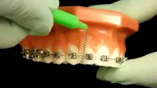 Bracesquestionscom  Brushing With Braces How to Brush Teeth [upl. by Salohcin]