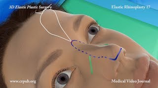 3D Elastic Rhinoplasty [upl. by Ettelloc319]