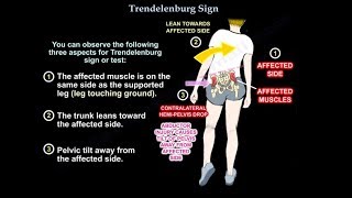 Trendelenburg Sign  Everything You Need To Know  Dr Nabil Ebraheim [upl. by Ellswerth]