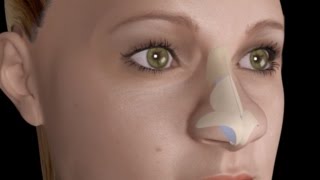 Bulbous Large Nasal Tip Nose Job Rhinoplasty [upl. by Otrebliw]