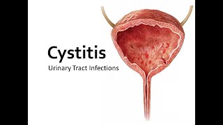 Cystitis lecture [upl. by Aisatnaf605]