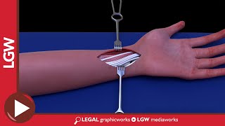 Wrist Fixator Surgery 3D Animation [upl. by Ahsinom56]