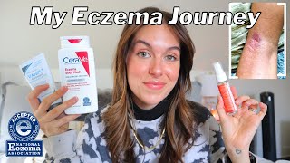 HOW I BEAT MY ECZEMA FOR GOOD  My journey product recommendations  body care tips  Rudi Berry [upl. by Eelirak]