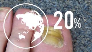 Safe and Effective Nail Fungus Treatment  Complete Video Guide [upl. by Neiv]