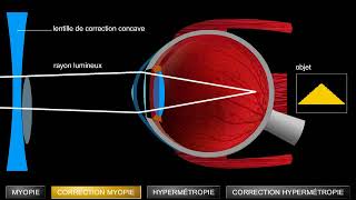 Troubles de la vision myopie et hypermétropie [upl. by Tiffany]