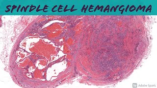 Spindle Cell Hemangioma 101 [upl. by Eceinaj44]