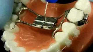 Bracesquestionscom  Orthodontic Jaw Expander How to Turn [upl. by Ahsienek]