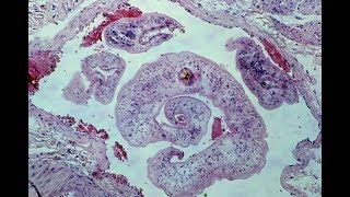 Schistosomiasis  Pathology mini tutorial [upl. by Beth985]