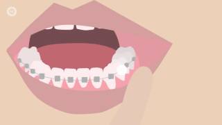 How To Deal With Braces Discomfort  Whats Normal Whats Not amp What To Do [upl. by Kitti349]