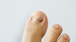 How to prevent and treat nail fungus [upl. by Murtha332]