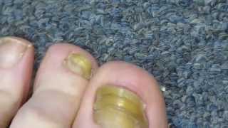 My Toenail Fungus Sucess Story [upl. by Margaretta]