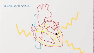 Ventricular Tachycardia  Types Causes and Treatment Approaches [upl. by Aita]