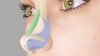 Saddle Nose or Ski Slope Nose Rhinoplasty Nosejob [upl. by Collimore163]