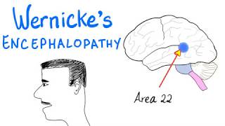 Wernickes Aphasia Fluent Aphasia  Neurology [upl. by Palermo]