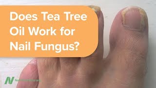 Does Tea Tree Oil Work for Nail Fungus [upl. by Byrd]