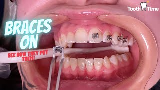 How do they put braces on  Tooth Time Family Dentistry New Braunfels [upl. by Anerec817]