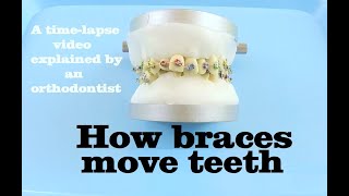 How braces move teeth timelapse  Braces Explained [upl. by Aramot690]