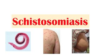 Schistosomiasis  Bilharziasis  Causes Symptoms and Treatment [upl. by Afihtan]