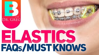 Braces Elastics  Rubber Bands – 5 Most Common Questions [upl. by Air]