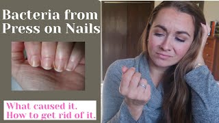 AVOID Nail Bacteria from Press on Nails  What I did  How to get rid of it [upl. by Kinemod241]