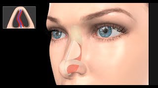 Deviated Septum Surgery Septoplasty [upl. by Godfree]