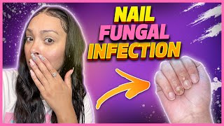 How I got a nail fungal infectionand treated it [upl. by Weldon]