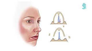 Rhinoplasty Detailed animation about the operation [upl. by Zetana]