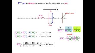 Correction des défauts de l’œil  HYPERMÉTROPIE [upl. by Darnok]