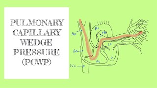 Pulmonary capillary wedge pressure PCWP [upl. by Airbma]